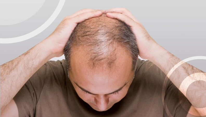Hair Transplant 1