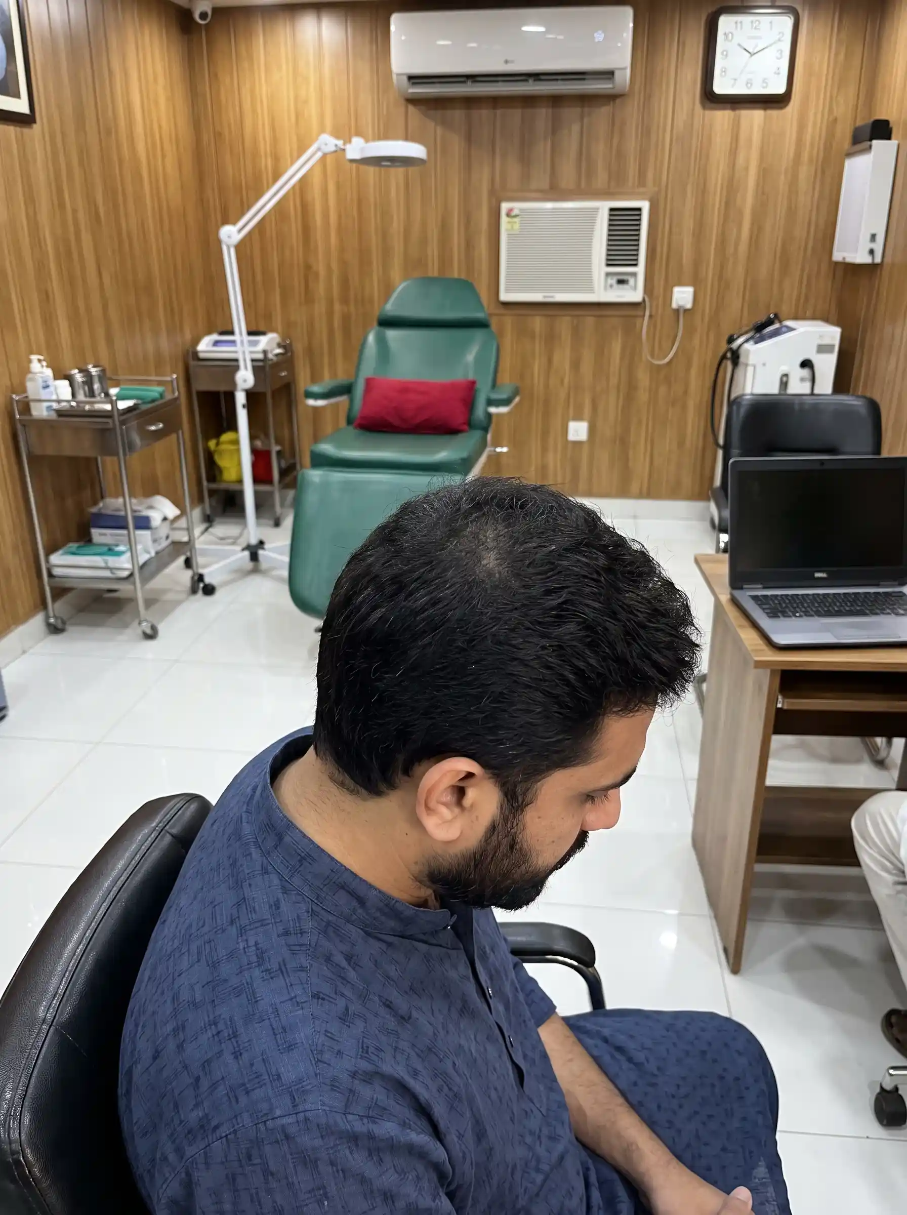 Crown Hair Transplant Result
