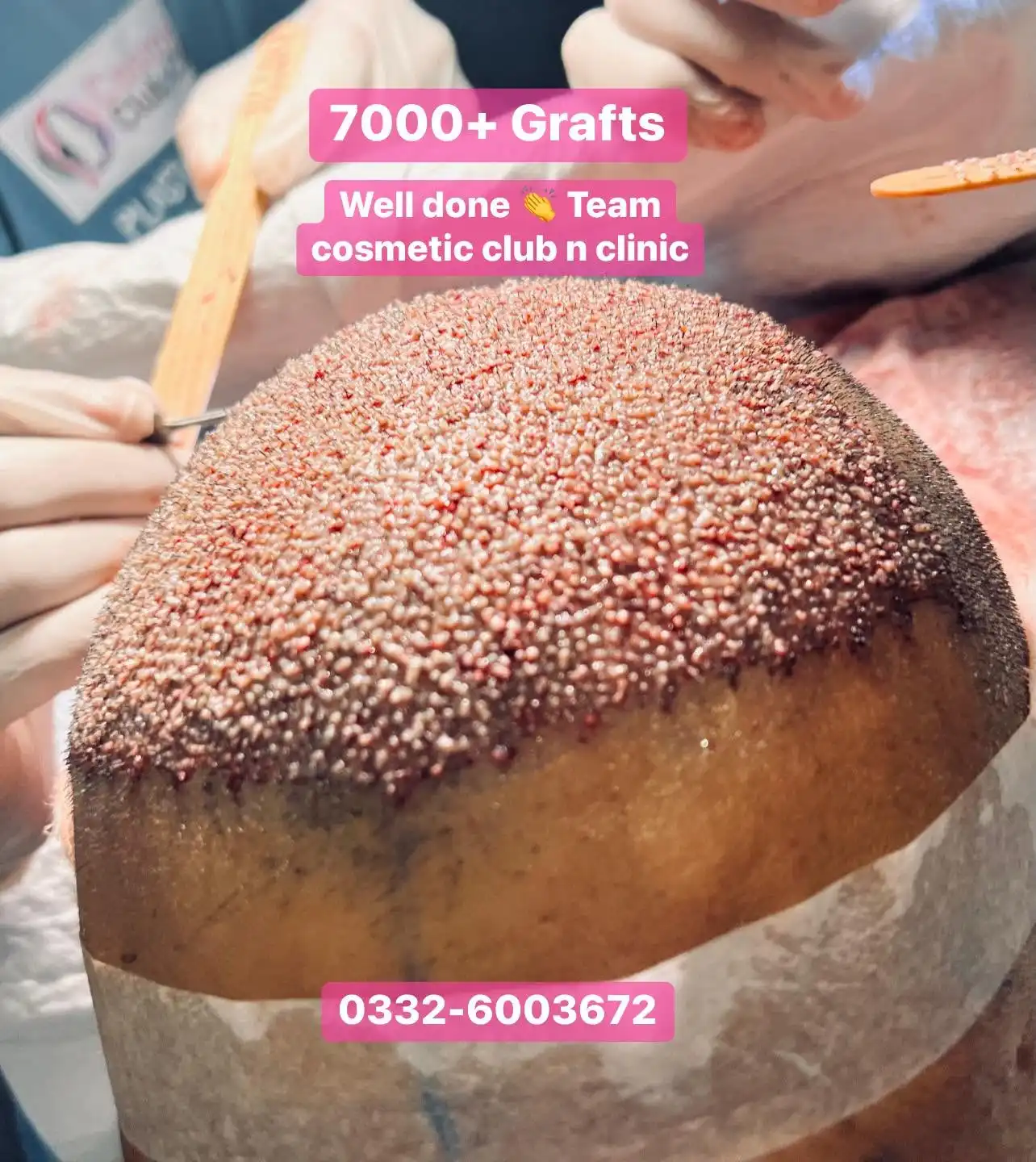 Hair transplant patient result showing thicker temple and hairline coverage several months post-procedure