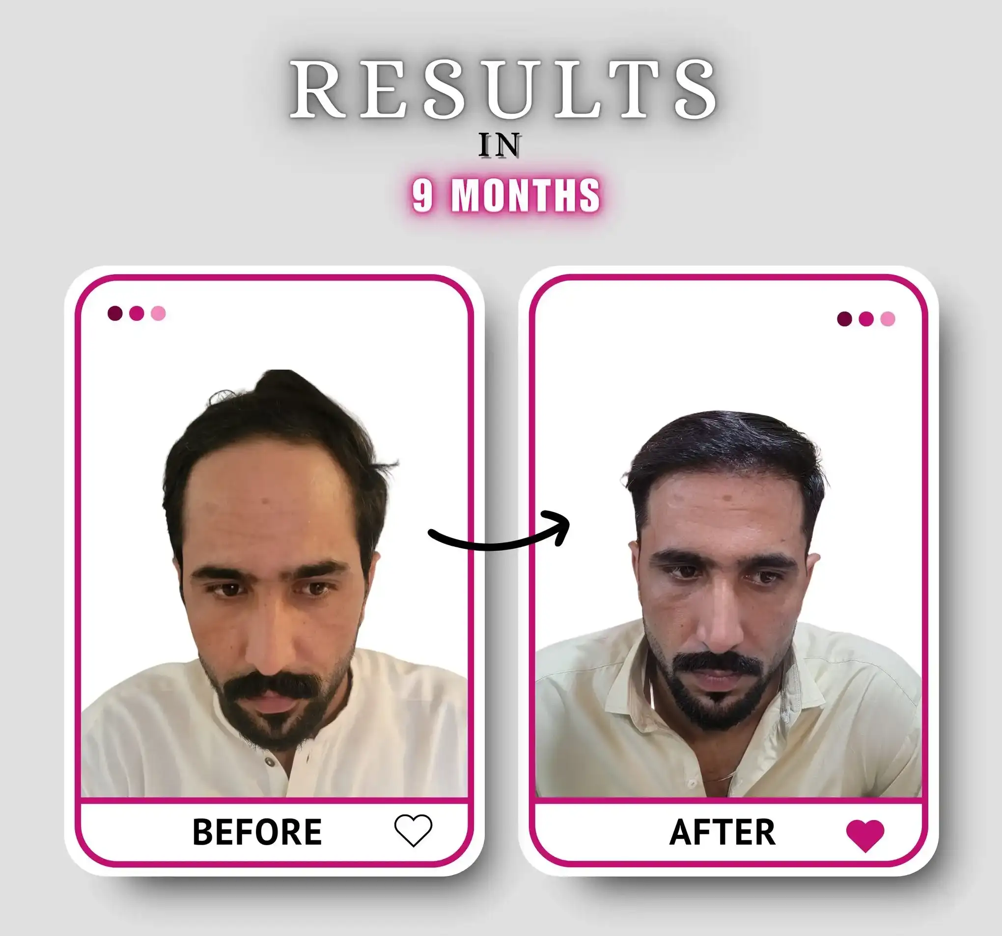 Post-transplant result showing a natural, evenly distributed hairline on a male patient