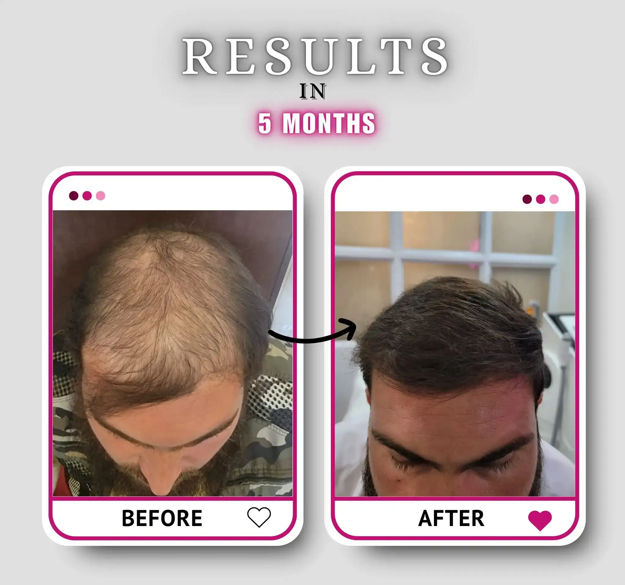 Hair restoration result with improved crown density and a defined frontal hairline
