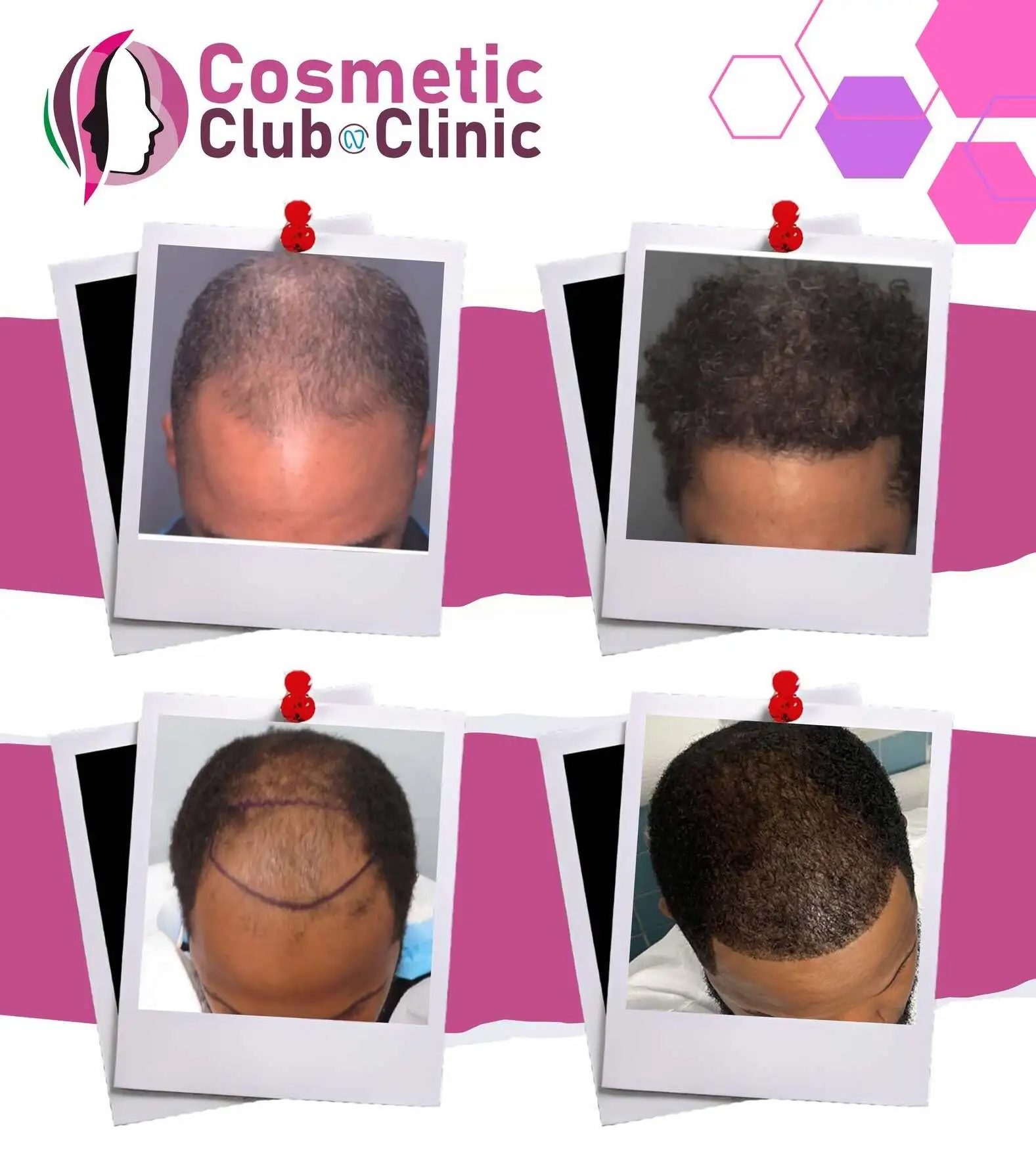 Healed hair transplant result showing natural growth direction and full frontal coverage