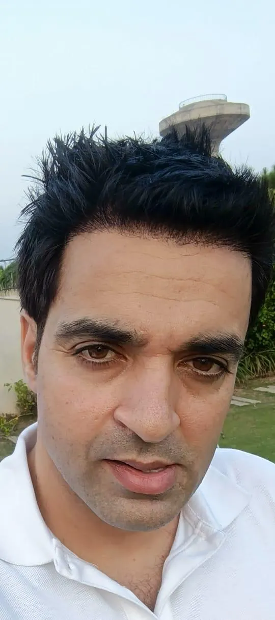 Before and after hair transplant result showing restored density across the crown of a male patient at Cosmetic Club N Clinic