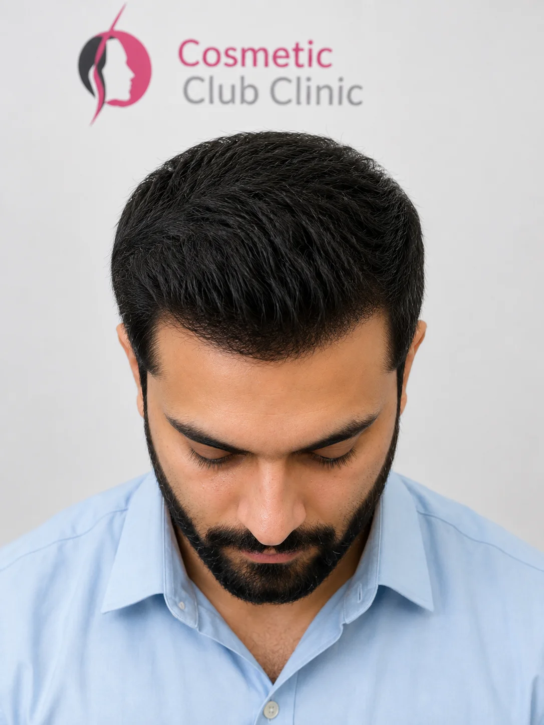 After photo of a male pattern baldness patient with dense regrowth across the mid-scalp and hairline
