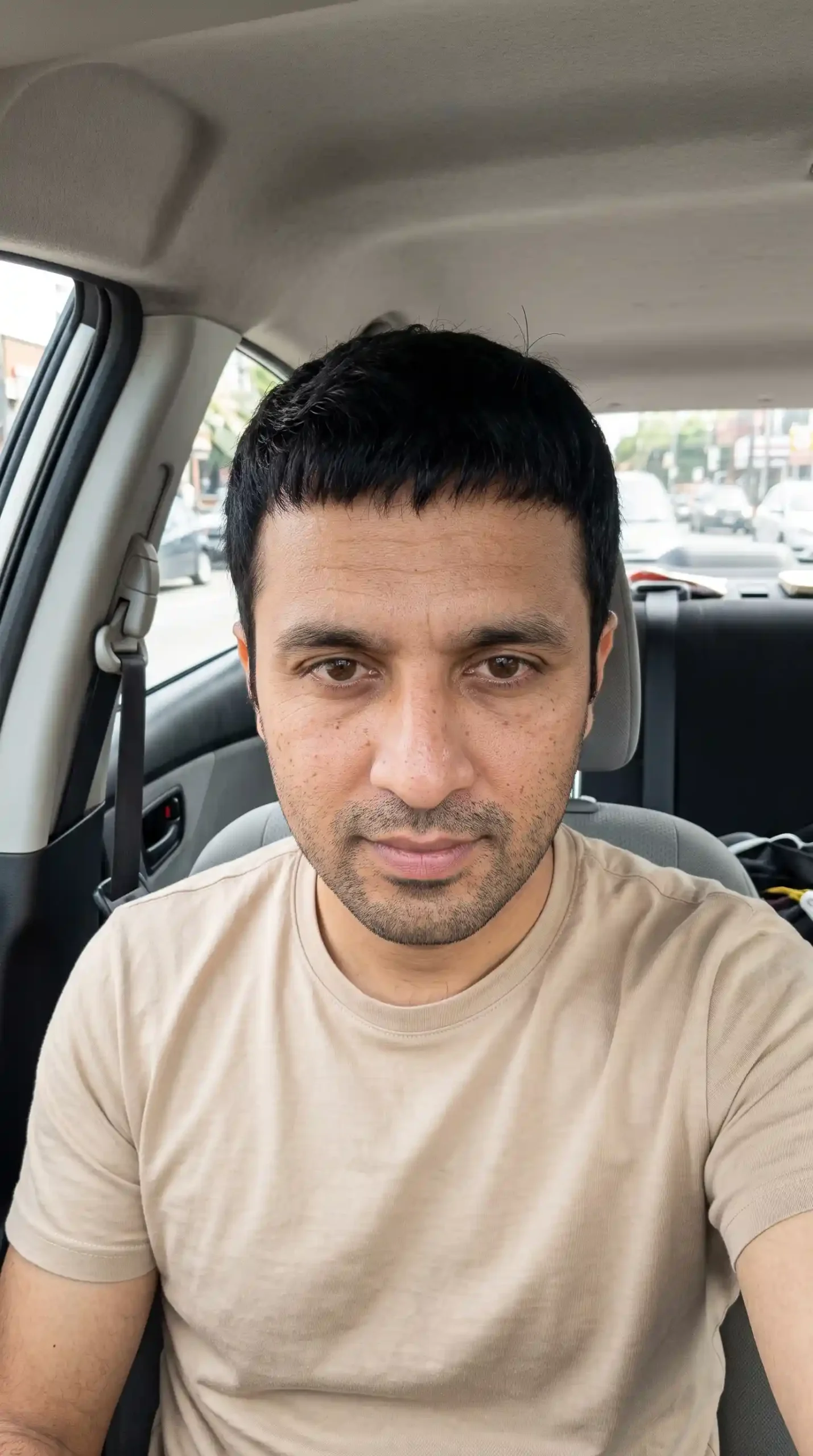Hair transplant result for patient Ameen Afridi showing restored front and mid-scalp coverage